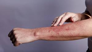 Image showing skin rashes